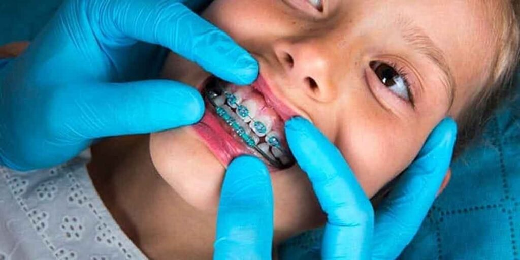 The Benefits of Early Orthodontic Treatment for Children