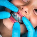The Benefits of Early Orthodontic Treatment for Children