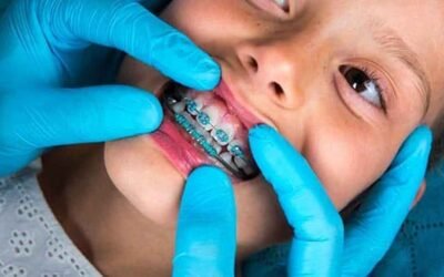 The Benefits of Early Orthodontic Treatment for Children